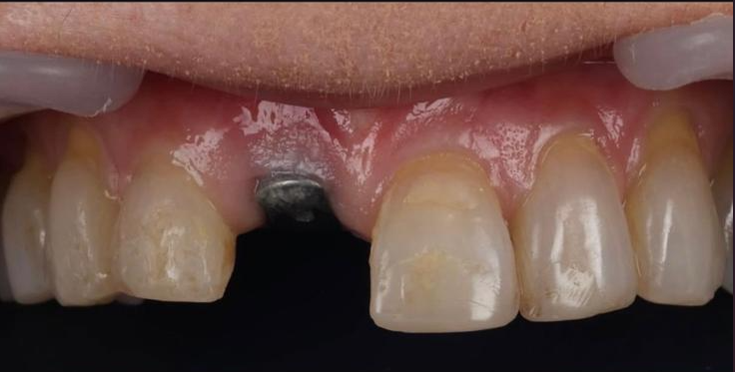 Single Implant before treatment